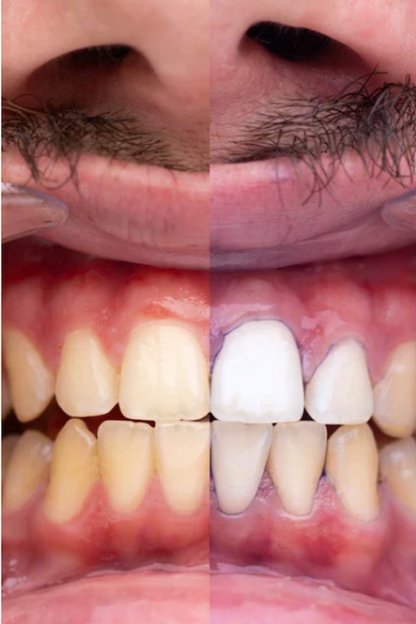 PURPLE V34 - Blanqueador Dental