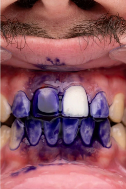 PURPLE V34 - Blanqueador Dental